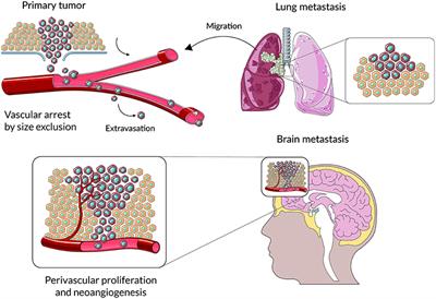 Immune Microenvironment of Brain Metastases—Are Microglia and Other Brain Macrophages Little Helpers?